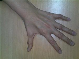 Giải cứu bàn tay teo liệt sau 10 năm chưa rõ nguyên nhân